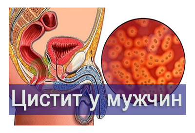 Лечение лучевого цистита в Краснодаре в клинике УРО-ПРО