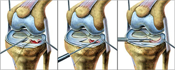 Повреждение хряща колена мениска